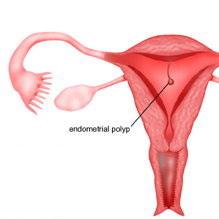 Endometrial Polyps treatment Meerut