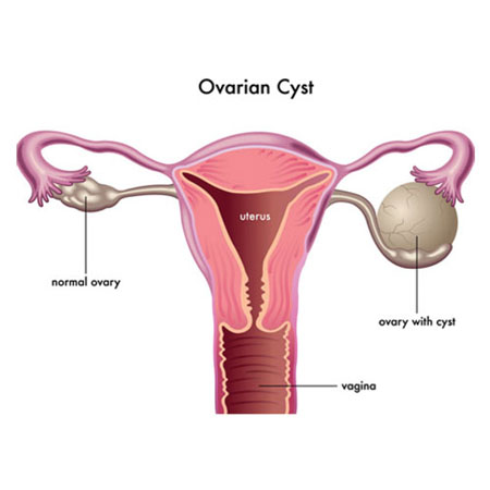 Laparoscopic Ovarian Cystectomy Specialist Meerut